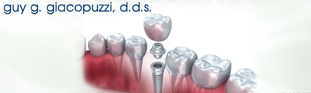 Dr. Guy Giacopuzzi DDS, for the ultimate in fine dental health, Implant dentistry, CBCT 3D endodontics, digital impressions, Platelet-rich fibrin (PRF), ortho guided minor tooth movement to close contacts, STA anesthesia, and offical distributor for Fancy Floss: Dental Floss Device, Lake Arrowhead, California, 92352.
